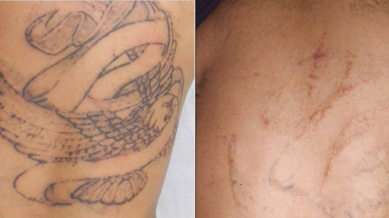 Questions Tattoo Removal Patients Should Ask Before Removing Tattoo 