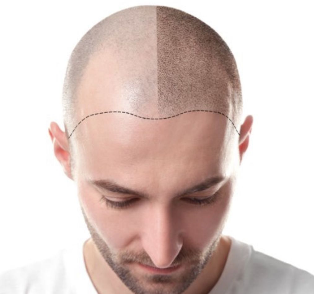 Is Scalp Micropigmentation permanent Treatment?