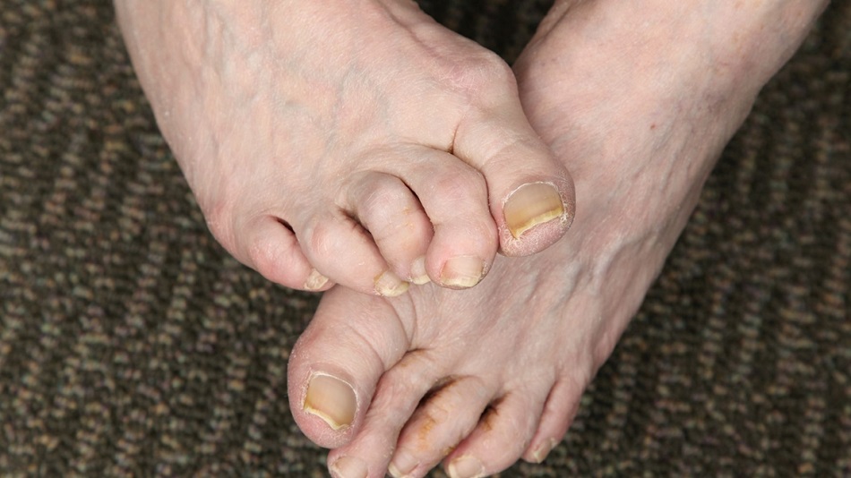 When is Surgery Necessary for Hammer Toe Repair?