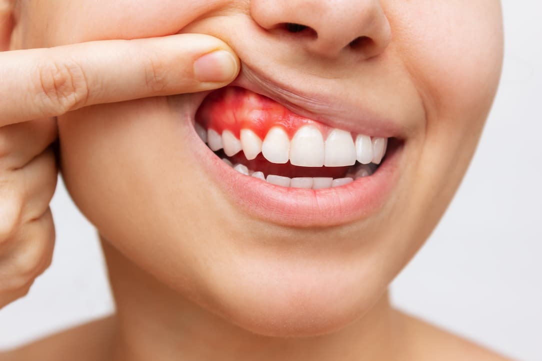 What are the Common Causes of Bleeding Gums in San Diego?