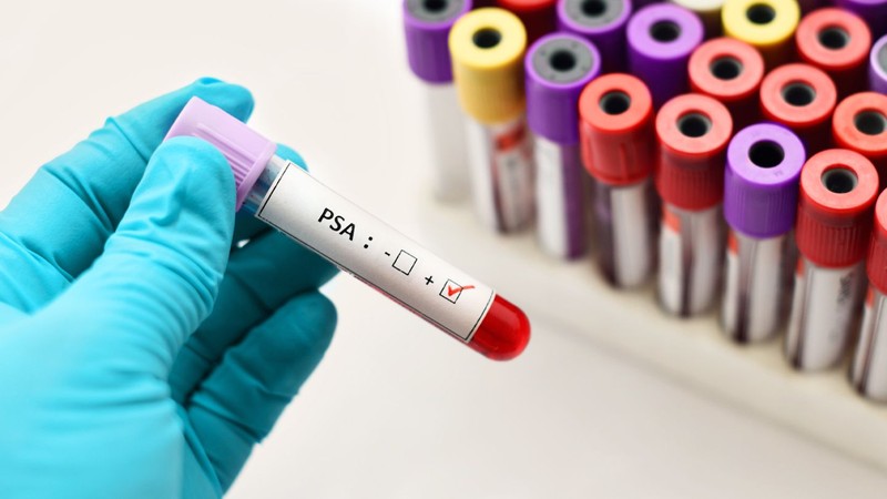 The Best PSA Tests With Its Types