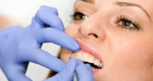 Ceramic Braces – Everything You Need to Know