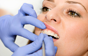 Ceramic Braces – Everything You Need to Know