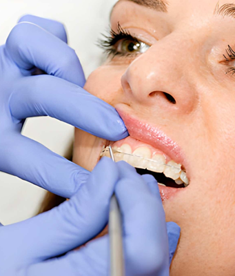 Ceramic Braces – Everything You Need to Know