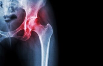 Renewing Mobility: A Journey of Knee Cartilage Regeneration of Emily Brown