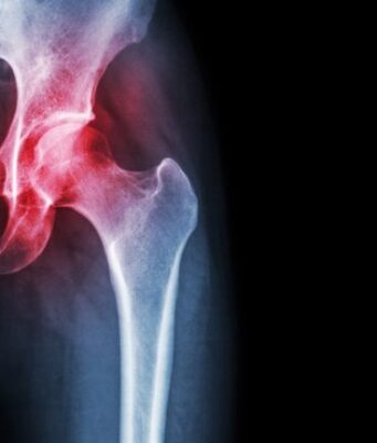 Renewing Mobility: A Journey of Knee Cartilage Regeneration of Emily Brown