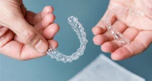 Step-by-Step Guide: How Clear Aligner Works