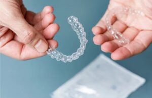 Step-by-Step Guide: How Clear Aligner Works