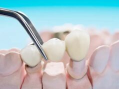 Step-by-Step Guide: How Clear Aligner Works