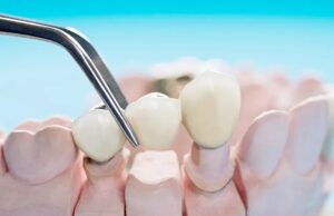 Step-by-Step Guide: How Clear Aligner Works