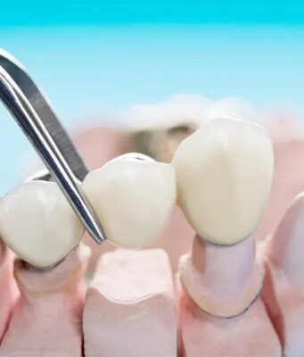 Step-by-Step Guide: How Clear Aligner Works