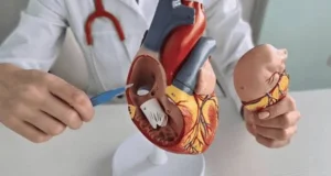 Tissue Valve Replacement or Mechanical Valve: Durability, Blood Thinners, Age and How to Decide With Your Cardiologist
