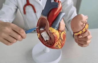 Tissue Valve Replacement or Mechanical Valve: Durability, Blood Thinners, Age and How to Decide With Your Cardiologist