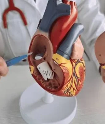 Tissue Valve Replacement or Mechanical Valve: Durability, Blood Thinners, Age and How to Decide With Your Cardiologist